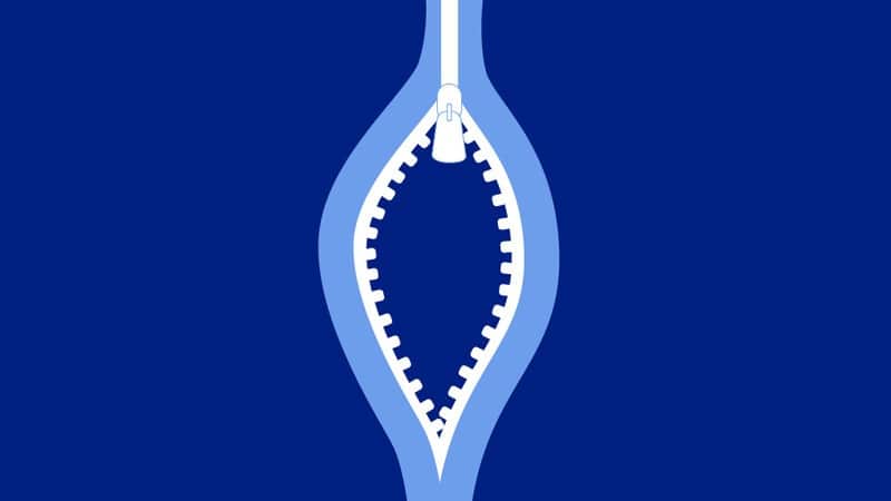 Vaginisme